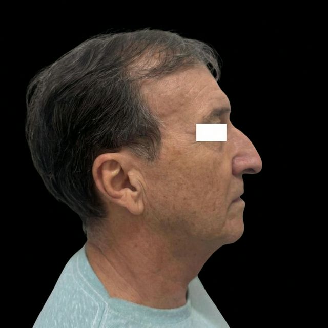 Antes